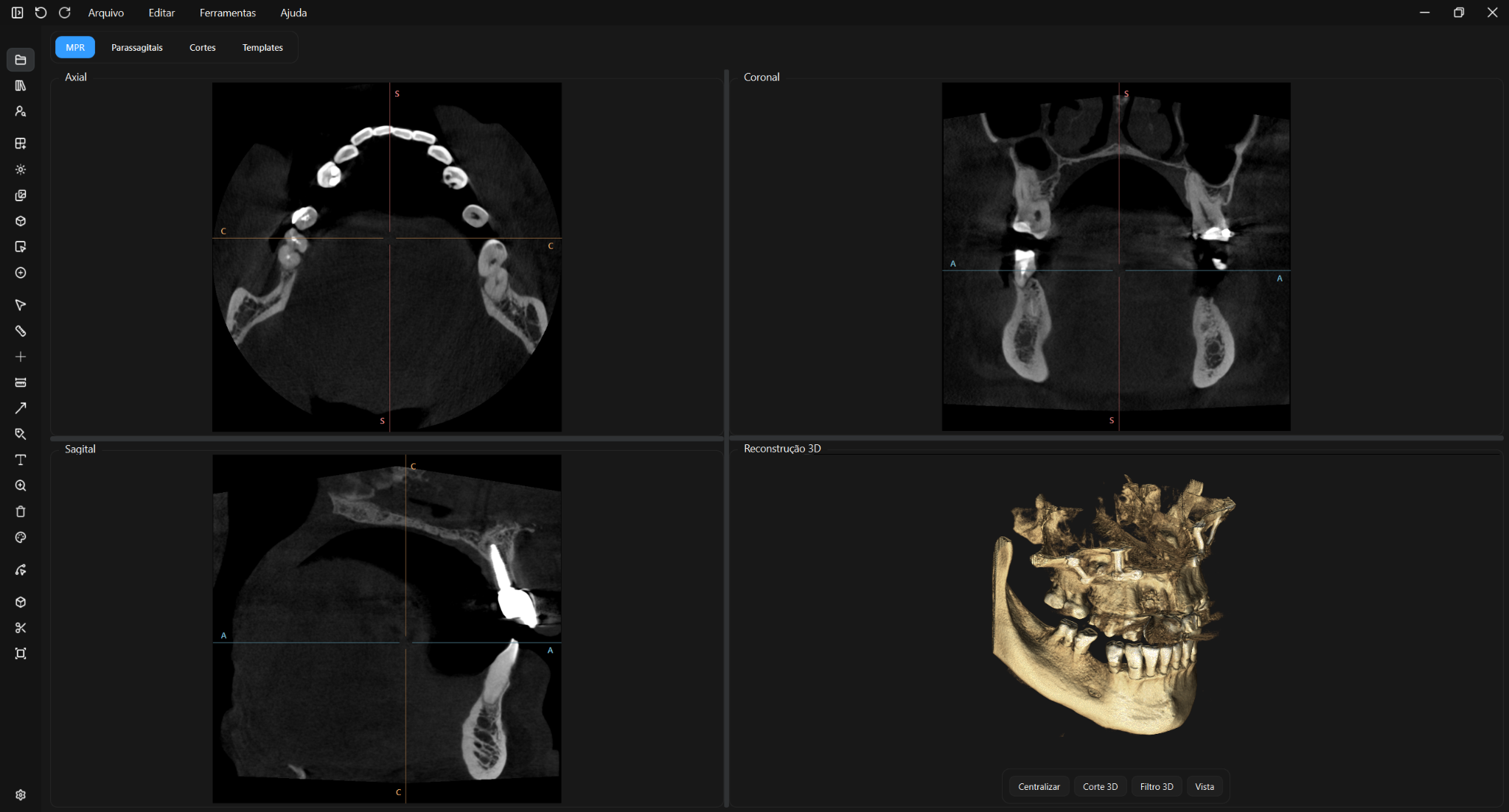 Interface real do Gamorion com vistas axial, coronal e sagital e reconstru&ccedil;&atilde;o 3D.